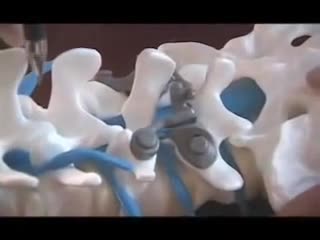 CẤP CỨU CHẤN THƯƠNG CỘT SỐNG VÀ TUỶ SỐNG 
