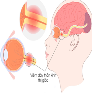 VIÊM TỦY THỊ THẦN KINH