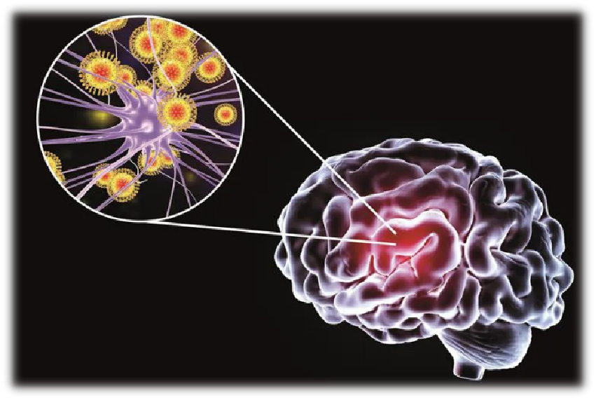 CHẨN ĐOÁN VIÊM NÃO DO HERPES SIMPLEX BẰNG CỘNG HƯỞNG TỪ (MRI)