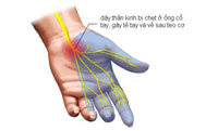 TÊ BÀN TAY VÀ HỘI CHỨNG ỐNG CỔ TAY