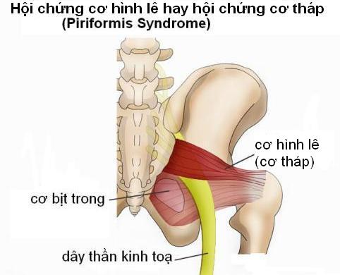 HỘI CHỨNG CƠ HÌNH LÊ (CƠ THÁP)