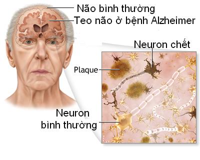 SA SÚT TRÍ TUỆ